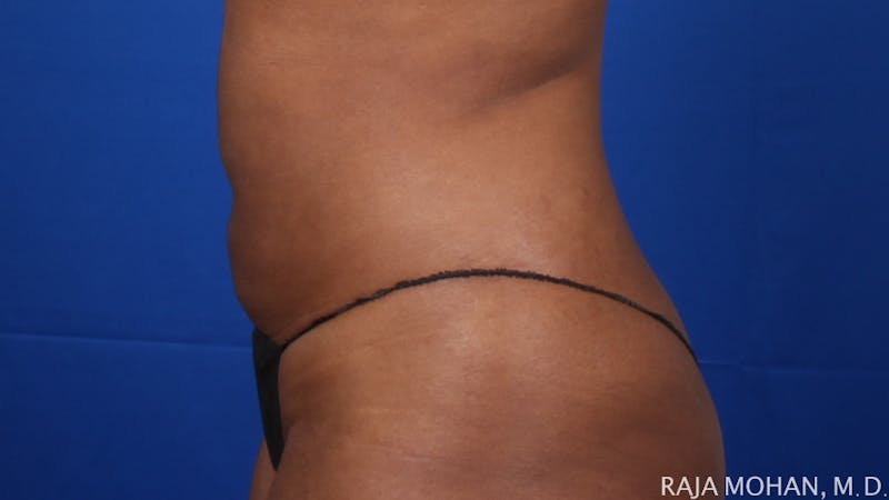 Liposuction Before & After Gallery - Patient 100759 - Image 130