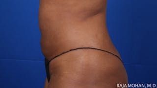 Liposuction Before & After Gallery - Patient 100759 - Image 130