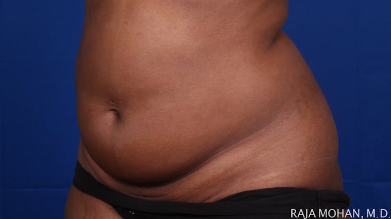 Liposuction Before & After Gallery - Patient 100759 - Image 131