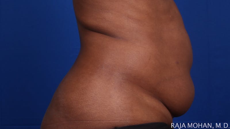 Liposuction Before & After Gallery - Patient 100759 - Image 133