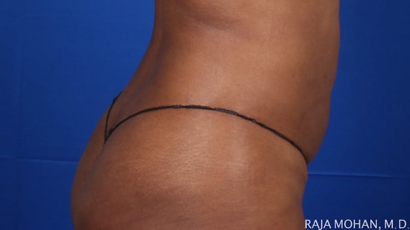 Liposuction Before & After Gallery - Patient 100759 - Image 134