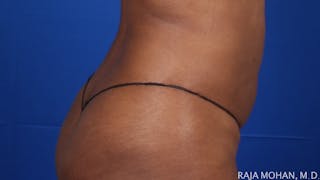 Liposuction Before & After Gallery - Patient 100759 - Image 134