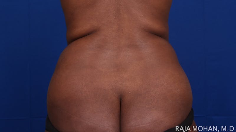 Liposuction Before & After Gallery - Patient 100759 - Image 135