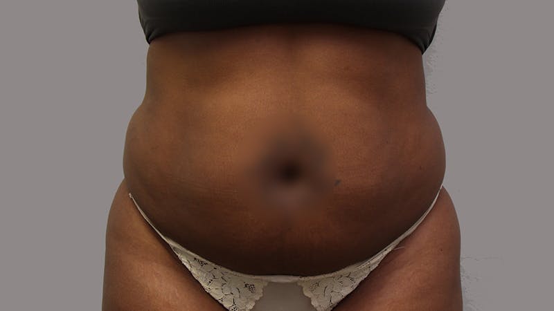 Liposuction Before & After Gallery - Patient 100759 - Image 137