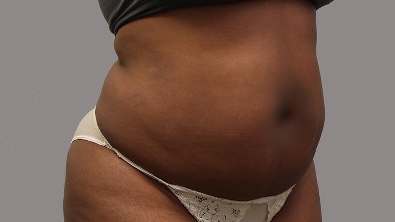 Liposuction Before & After Gallery - Patient 100759 - Image 139