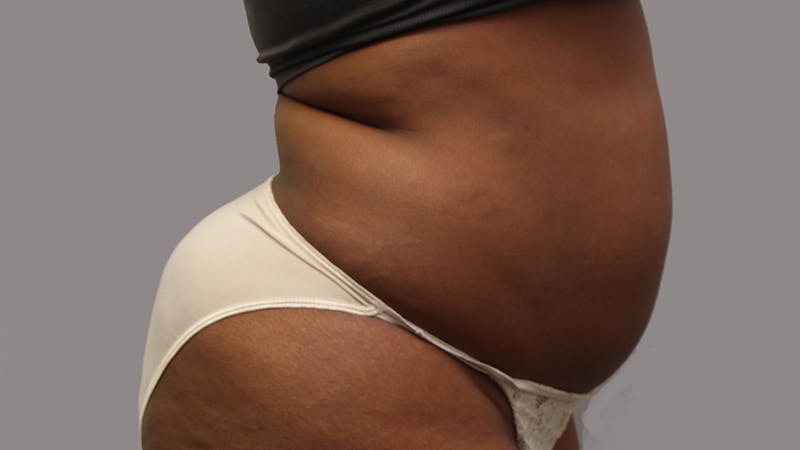 Liposuction Before & After Gallery - Patient 100759 - Image 141