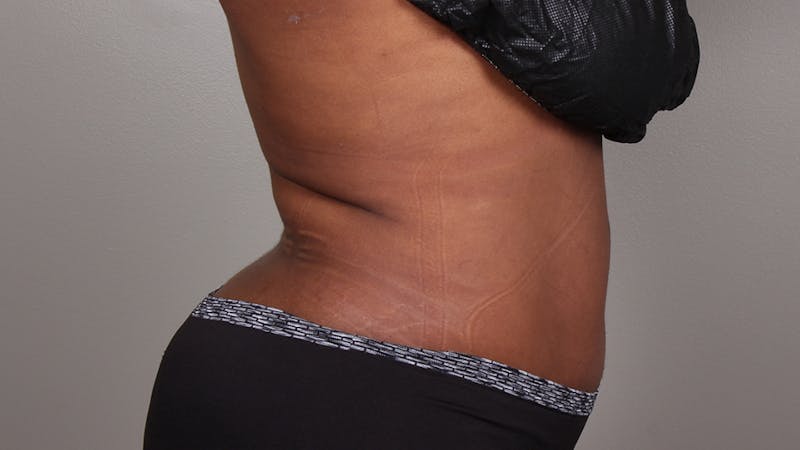 Liposuction Before & After Gallery - Patient 100759 - Image 142