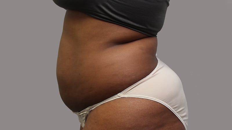 Liposuction Before & After Gallery - Patient 100759 - Image 143