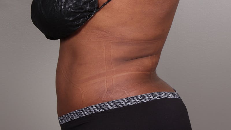 Liposuction Before & After Gallery - Patient 100759 - Image 144