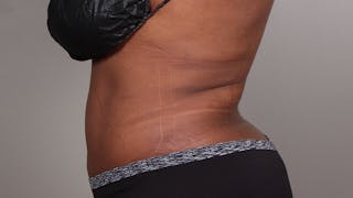Liposuction Before & After Gallery - Patient 100759 - Image 144