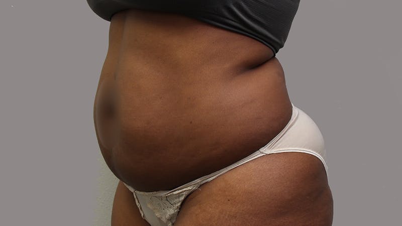 Liposuction Before & After Gallery - Patient 100759 - Image 145