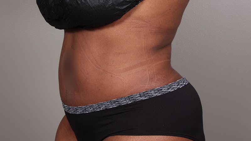 Liposuction Before & After Gallery - Patient 100759 - Image 146
