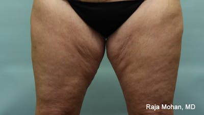 Thighplasty Before & After Gallery - Patient 232444 - Image 1