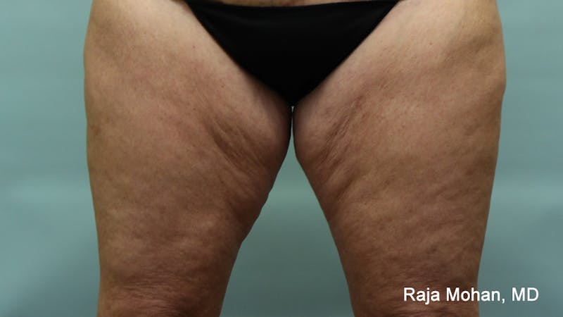 Thighplasty Before & After Gallery - Patient 232444 - Image 1