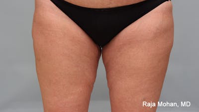 Thighplasty Before & After Gallery - Patient 232444 - Image 2