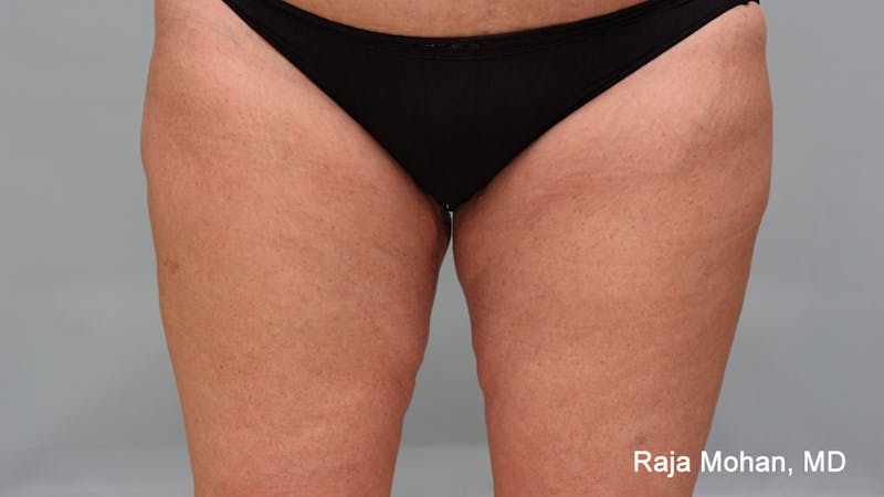 Thighplasty Before & After Gallery - Patient 232444 - Image 2