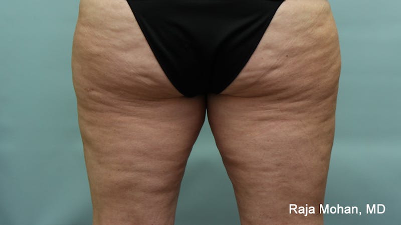 Thighplasty Before & After Gallery - Patient 232444 - Image 3