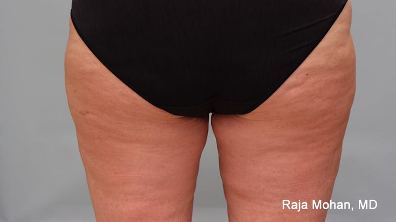 Thighplasty Before & After Gallery - Patient 232444 - Image 4