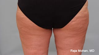 Thighplasty Before & After Gallery - Patient 232444 - Image 4