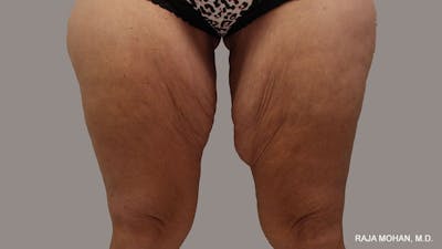 Thighplasty Before & After Gallery - Patient 267973 - Image 1