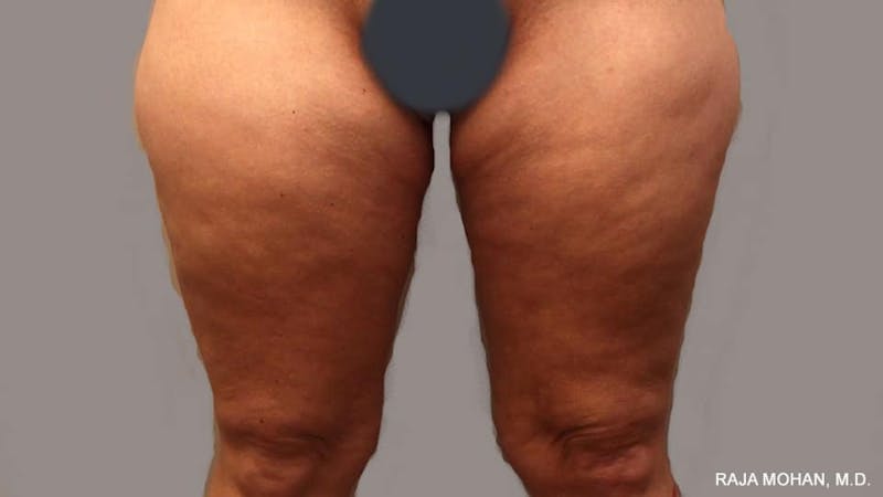 Thighplasty Before & After Gallery - Patient 267973 - Image 2