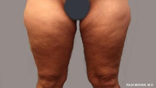 Thighplasty Before & After Gallery - Patient 267973 - Image 2