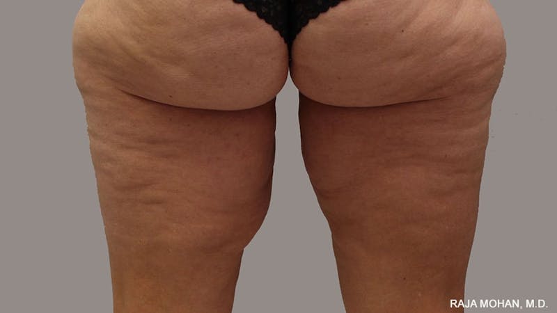 Thighplasty Before & After Gallery - Patient 267973 - Image 3