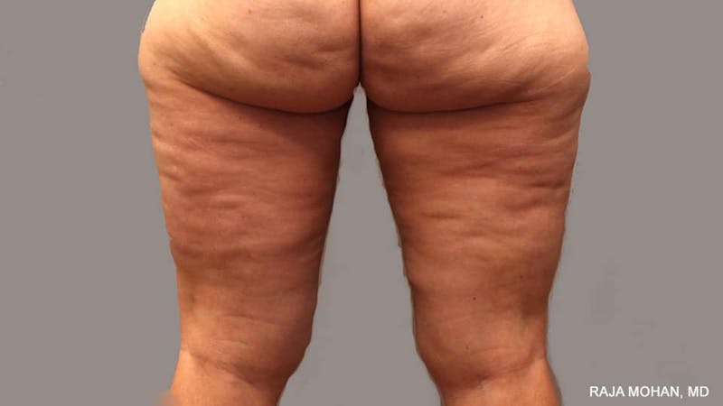 Thighplasty Before & After Gallery - Patient 267973 - Image 4