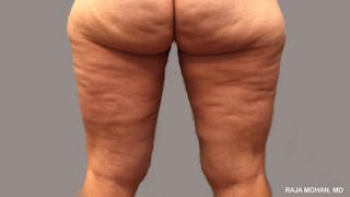 Thighplasty Before & After Gallery - Patient 267973 - Image 4