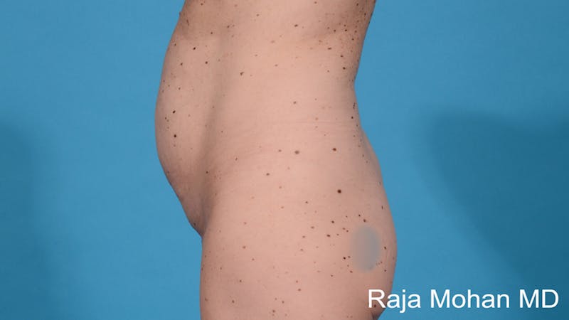 Tummy Tuck Before & After Gallery - Patient 231515 - Image 3