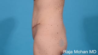 Tummy Tuck Before & After Gallery - Patient 231515 - Image 4