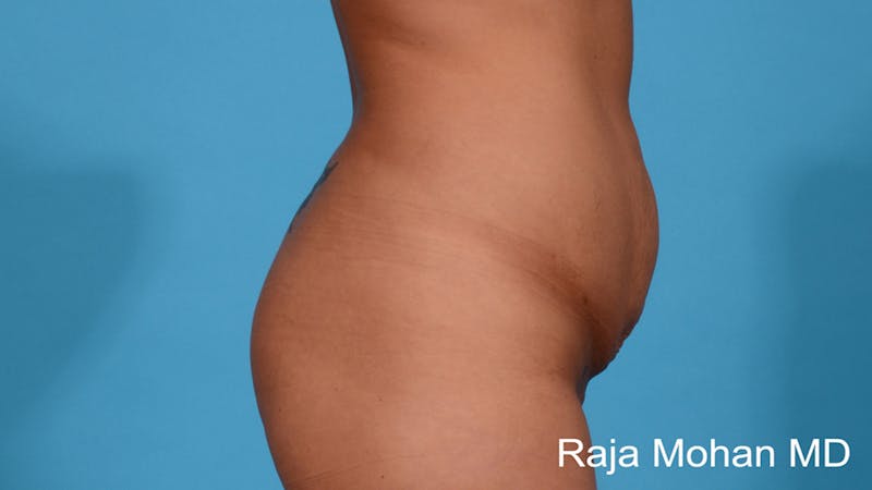 Tummy Tuck Before & After Gallery - Patient 255370 - Image 3
