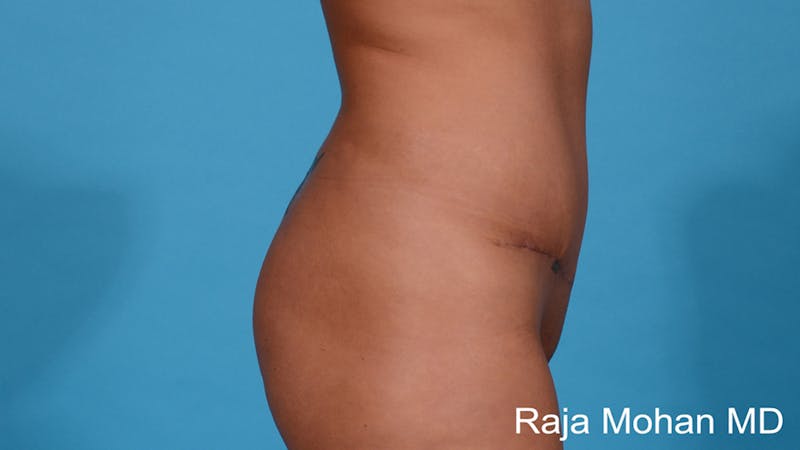Tummy Tuck Before & After Gallery - Patient 255370 - Image 4