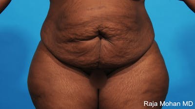 Tummy Tuck Before & After Gallery - Patient 203077 - Image 1
