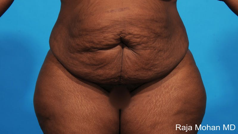 Tummy Tuck Before & After Gallery - Patient 203077 - Image 1
