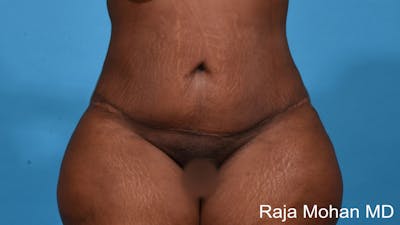Tummy Tuck Before & After Gallery - Patient 203077 - Image 2