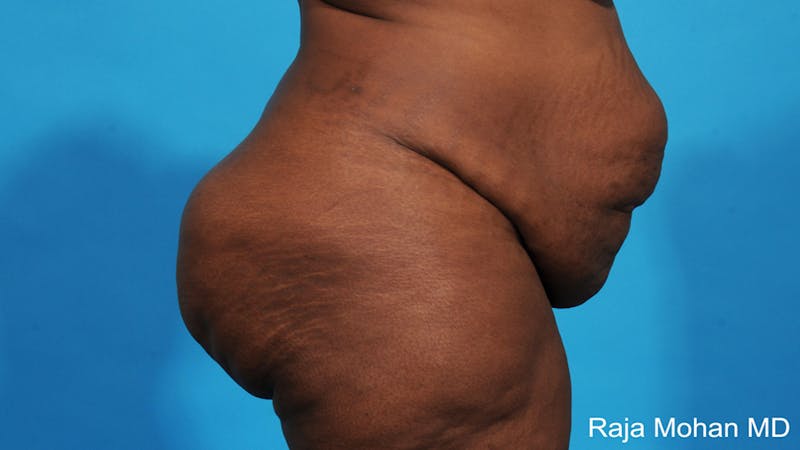 Tummy Tuck Before & After Gallery - Patient 203077 - Image 3