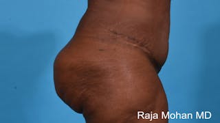 Tummy Tuck Before & After Gallery - Patient 203077 - Image 4