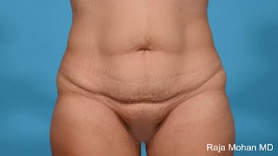 Tummy Tuck Before & After Gallery - Patient 313933 - Image 1