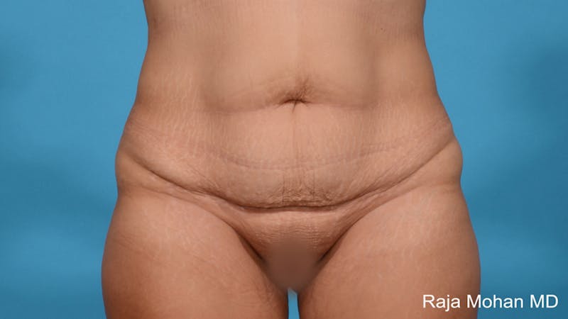 Tummy Tuck Before & After Gallery - Patient 313933 - Image 1