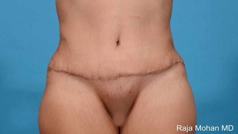 Tummy Tuck Before & After Gallery - Patient 313933 - Image 2