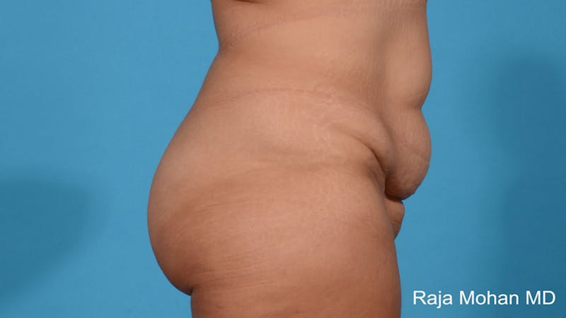 Tummy Tuck Before & After Gallery - Patient 313933 - Image 3