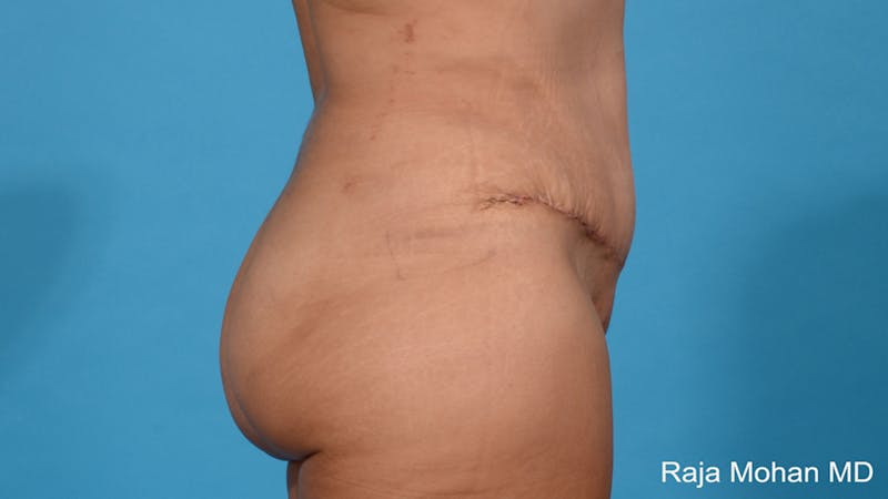 Tummy Tuck Before & After Gallery - Patient 313933 - Image 4