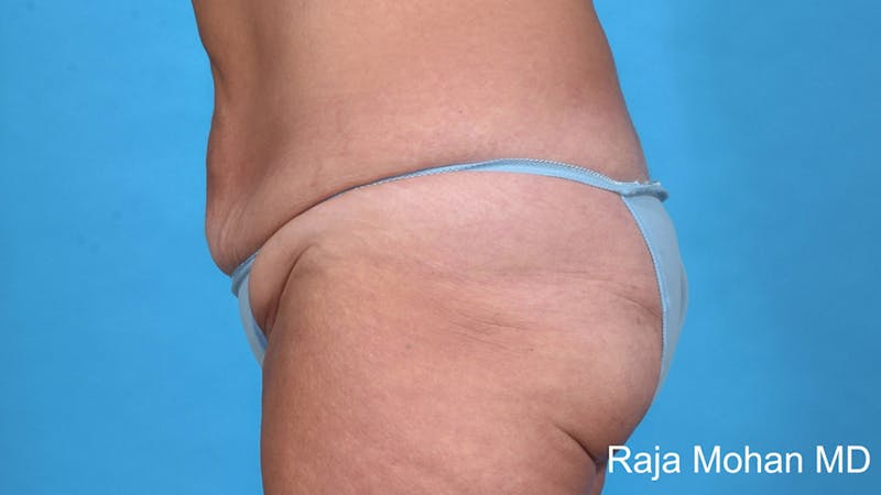Tummy Tuck Before & After Gallery - Patient 415205 - Image 3