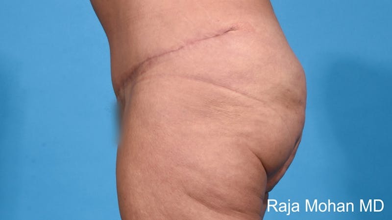 Tummy Tuck Before & After Gallery - Patient 415205 - Image 4