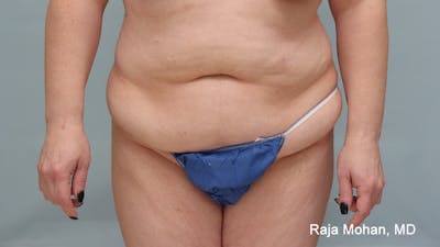 Tummy Tuck Before & After Gallery - Patient 190559 - Image 1