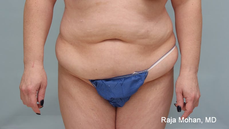 Tummy Tuck Before & After Gallery - Patient 190559 - Image 1