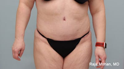 Tummy Tuck Before & After Gallery - Patient 190559 - Image 2