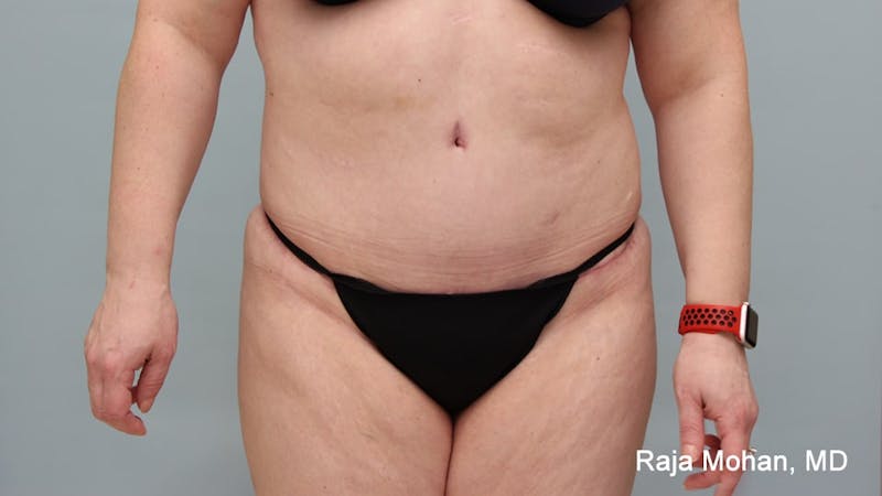 Tummy Tuck Before & After Gallery - Patient 190559 - Image 2