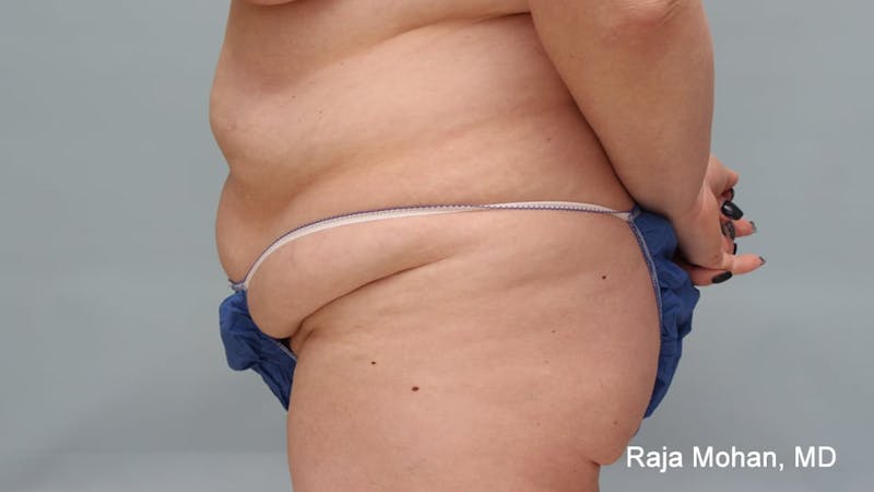 Tummy Tuck Before & After Gallery - Patient 190559 - Image 3